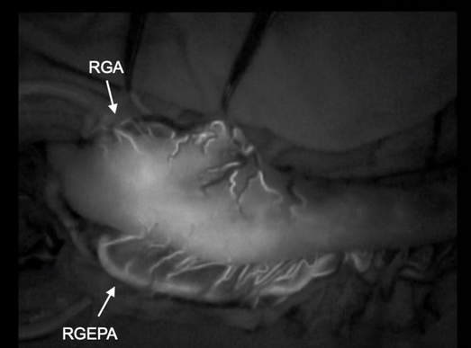 Modification of the lesser curvature incision line enhanced gastric conduit perfusion as determined by indocyanine green fluorescence imaging and decreased the incidence of anastomotic leakage following esophagectomy.