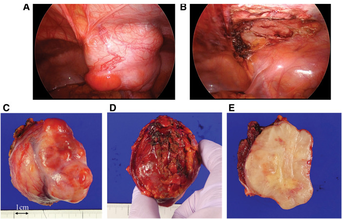 A Case of Inflammatory Myofibroblastic Tumor in the Abdominal Wall with Anaplastic Lymphoma Kinase and Whole Exome Sequencing Analysis.