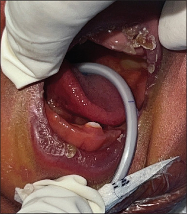 Diagnosis and Management of Natal Tooth Secondary to Beckwith-Wiedemann Syndrome in a 25-day-old Infant: A Rare Case Report.