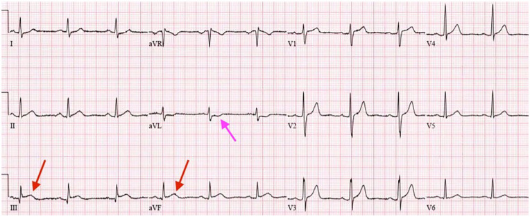 Premature Coronary Artery Disease Presenting as STEMI in a Teenager.