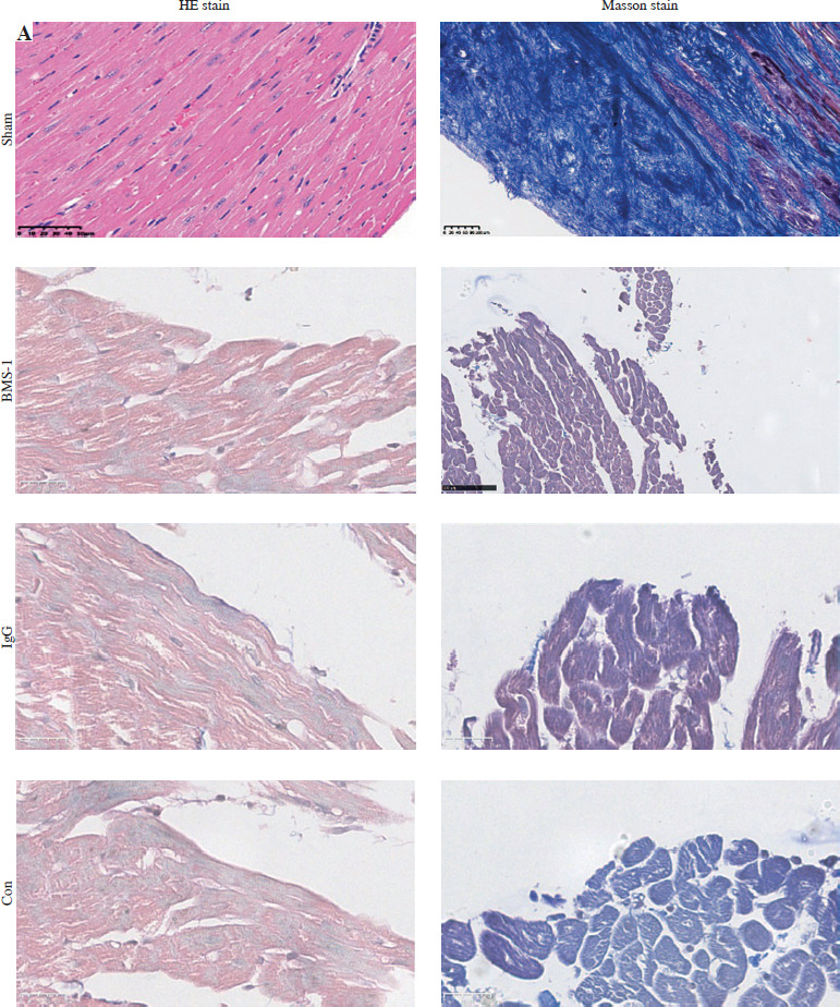 PD-1/PD-L1 inhibitor treatment associated with cardiotoxicity regulated by macrophage polarization and SOCS3/JAK/STAT3 signaling pathway.