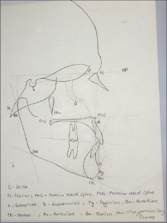 Ethnic Deviation of Northeastern Andhra Population from Standard Cephalometrics for Orthognathic Surgery - A Comparative Study.