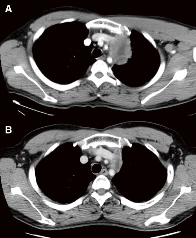 Long-Term Survival after Treatment with Induction Therapy and Surgery for Mediastinal Carcinoma of Unknown Primary.