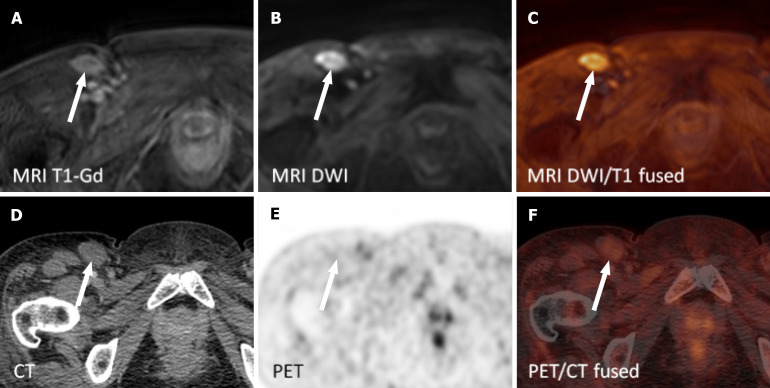 Whole-body magnetic resonance imaging provides accurate staging of diffuse large B-cell lymphoma, but is less preferred by patients.