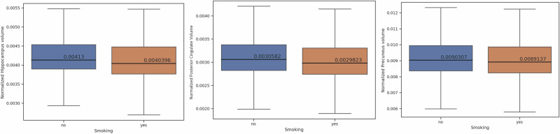 Smoking predicts brain atrophy in 10,134 healthy individuals and is potentially influenced by body mass index.