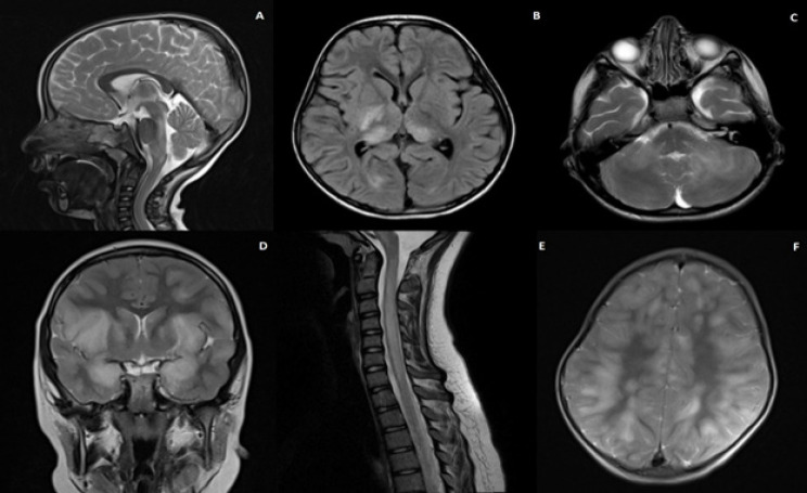 Gender and Age Differences in Seronegative Pediatric Acute Disseminated Encephalomyelitis Profiles: Results and Insights from a Tertiary Center.