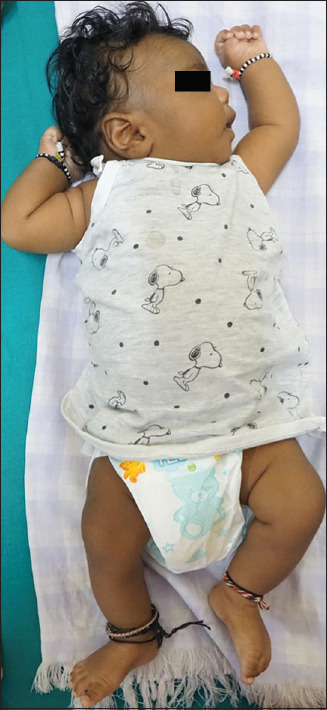 Diagnosis and Management of Natal Tooth Secondary to Beckwith-Wiedemann Syndrome in a 25-day-old Infant: A Rare Case Report.