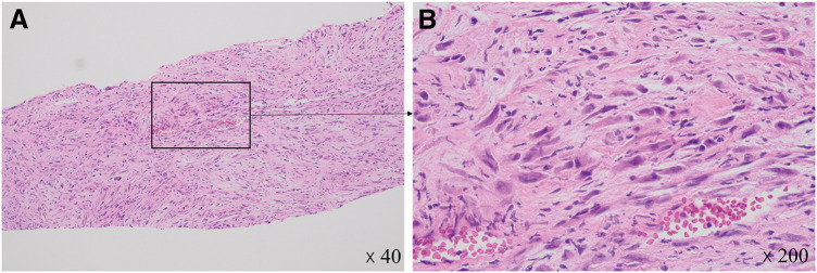 A Case of Inflammatory Myofibroblastic Tumor in the Abdominal Wall with Anaplastic Lymphoma Kinase and Whole Exome Sequencing Analysis.