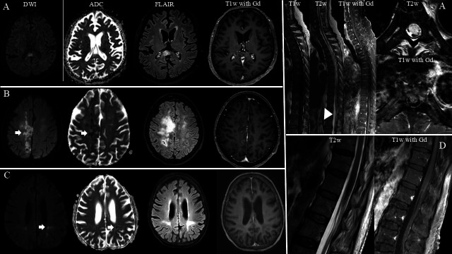 Clinical manifestations and outcomes of patients with intravascular large B-cell lymphoma with neurological involvement: highlighting longitudinally extensive myelopathy as a distinct feature.