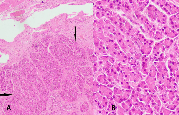Heterotopic Pancreatic Tissue in Gallbladder: A Report of an Unusual Entity at an Extremely Rare Location.