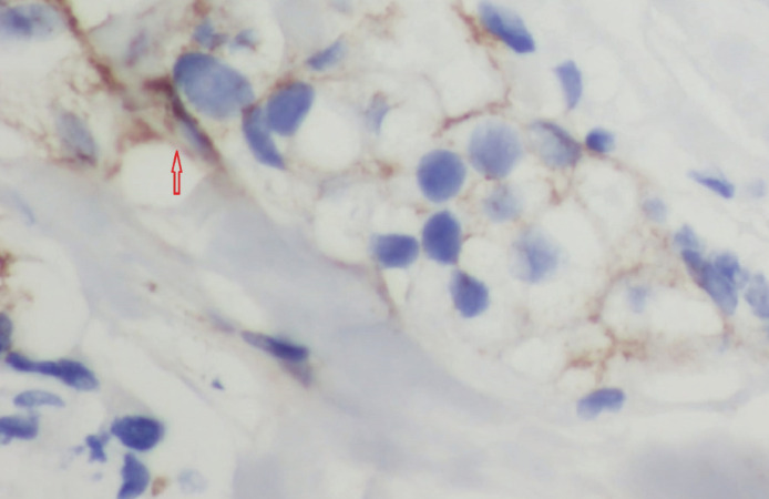 Carbonic Anhydrase IX Enzyme in Triple Negative Breast Carcinoma: Relationship With Prognostic Factors and Response to Neoadjuvant Chemotherapy.