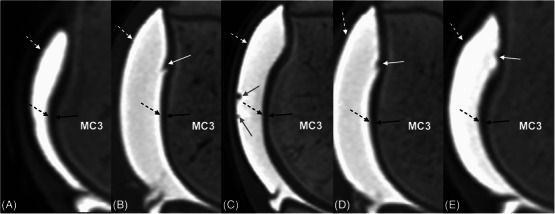 Ultrasonographic assessment of equine metacarpal cartilage thickness is more accurate than computed tomographic arthrography.