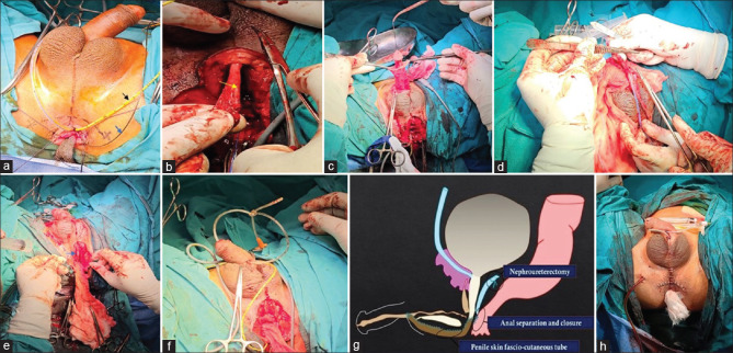 Urethral duplication with five openings in anal canal: A novel case report.