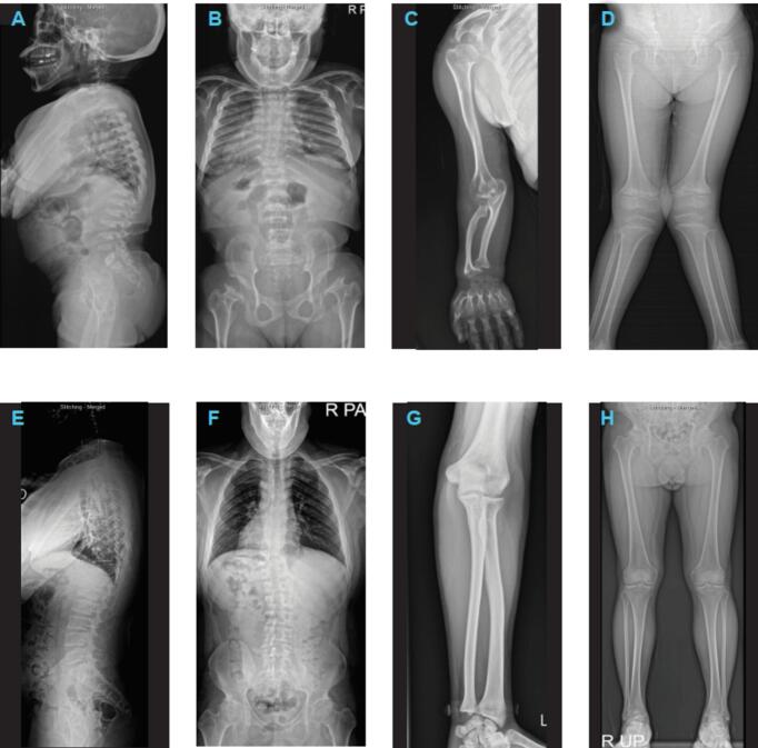 Long-term outcomes of enzyme replacement therapy from a large cohort of Korean patients with mucopolysaccharidosis IVA (Morquio A syndrome)
