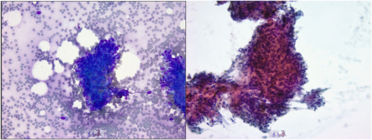 A case report: Endobronchial ultrasound guided biopsy of radiographically normal size thoracic lymph nodes supporting diagnosis of cardiac sarcoidosis