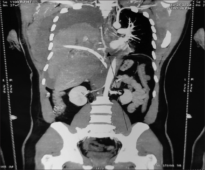 Massive Hemothorax due to a Rare Entity: Dilemma of ICD Insertion!! A Case Report.