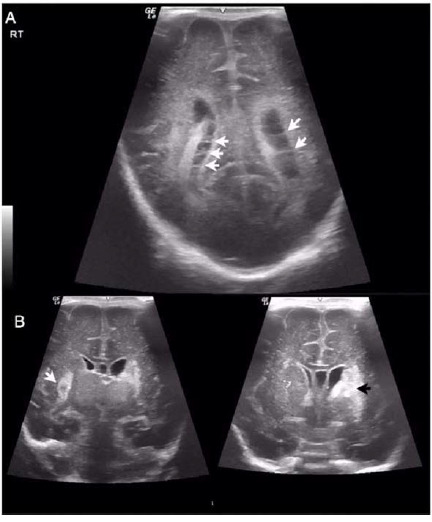 Breast milk-associated late-onset group B streptococcus sepsis in preterm triplets: A case report and literature review.
