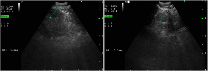 A case report: Endobronchial ultrasound guided biopsy of radiographically normal size thoracic lymph nodes supporting diagnosis of cardiac sarcoidosis