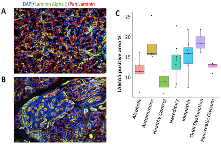 Correlation of Pancreatic Laminin Alpha 5 Expression With Clinical Outcomes in Total Pancreatectomy With Islet Autotransplantation.