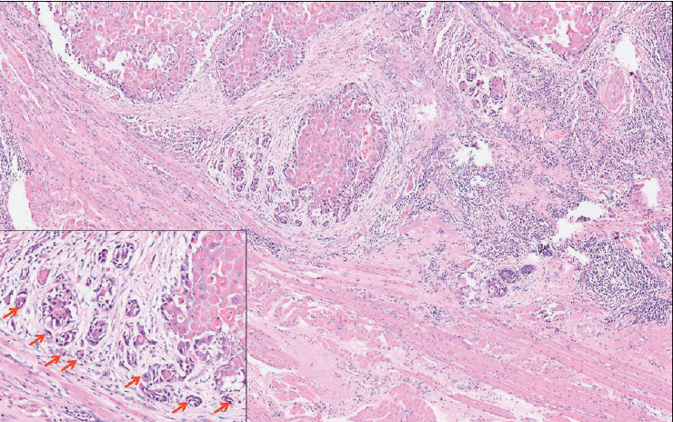 Tumor Budding as an Independent Prognostic Histopathological Marker in Oral Squamous Cell Carcinoma - An Indian Tertiary Care Center Experience.