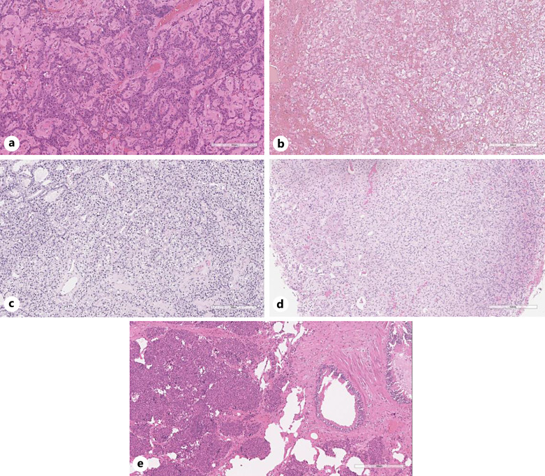 A Comprehensive Target Panel Allows to Extend the Genetic Spectrum of Neuroendocrine Tumors.