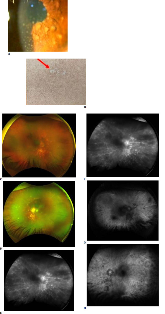 Fern-Like Pattern on Ultra-Widefield Fluorescein Angiography Across Various Uveitic Conditions.