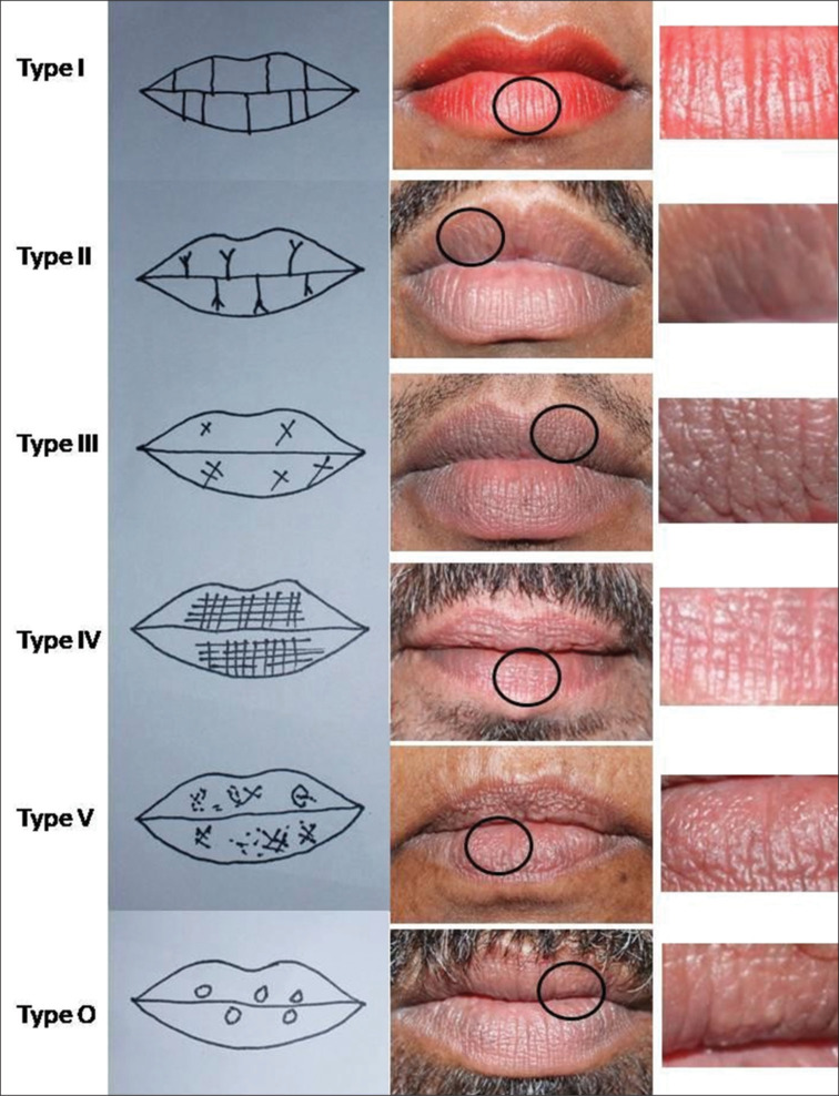 Dermatoglyphics and cheiloscopy in inheritance of oral clefts in North Indian population.