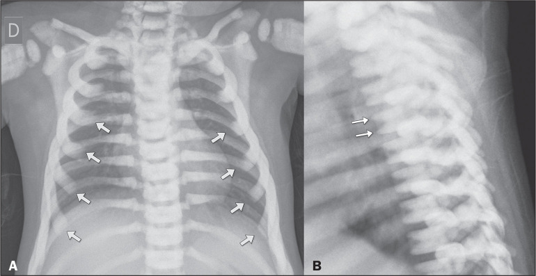 Sclerosing bone dysplasias: a pictorial essay.