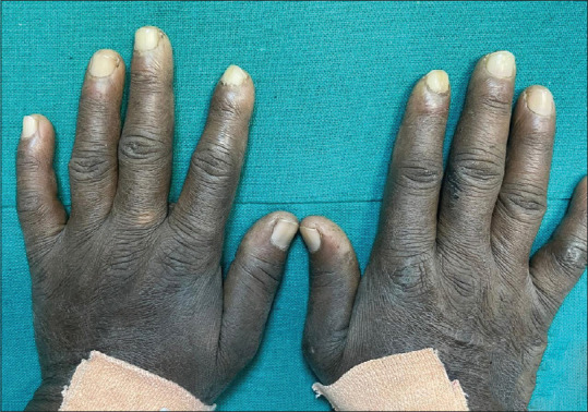 Efficacy of rituximab in treating systemic sclerosis in HIV-positive patients: A novel case report.