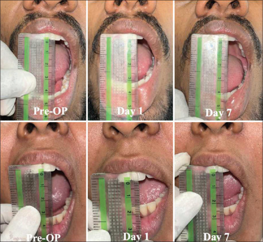 Gender Difference in Pain Perception and Post-surgery Satisfaction Following Impacted Mandibular Third Molar Surgery - A Comparative Study.