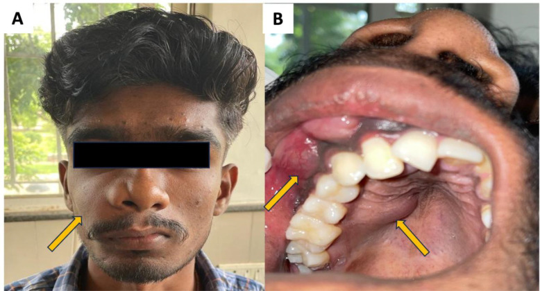 Unusual Maxillary Swelling in a 21-Year-Old Male - A Case Report.