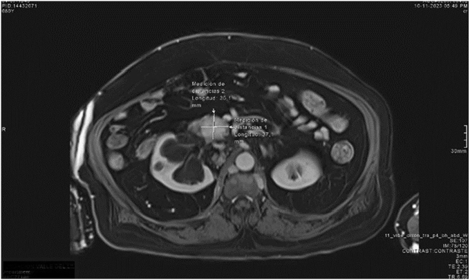 Successful Treatment of Benign Insulinoma by Transcatheter Angioembolization