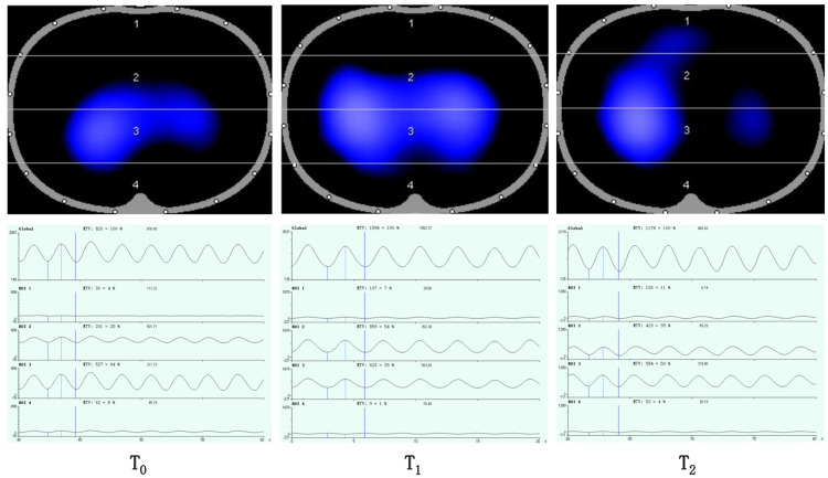 Awake prone positioning and ventilation distribution as assessed by electric impedance tomography in patients with non-COVID-19 acute hypoxemic respiratory failure: A prospective physiology study