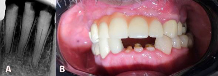 Guided Endodontic Technique in Mandibular Incisors with Pulp Canal Obliteration: A Case Report.