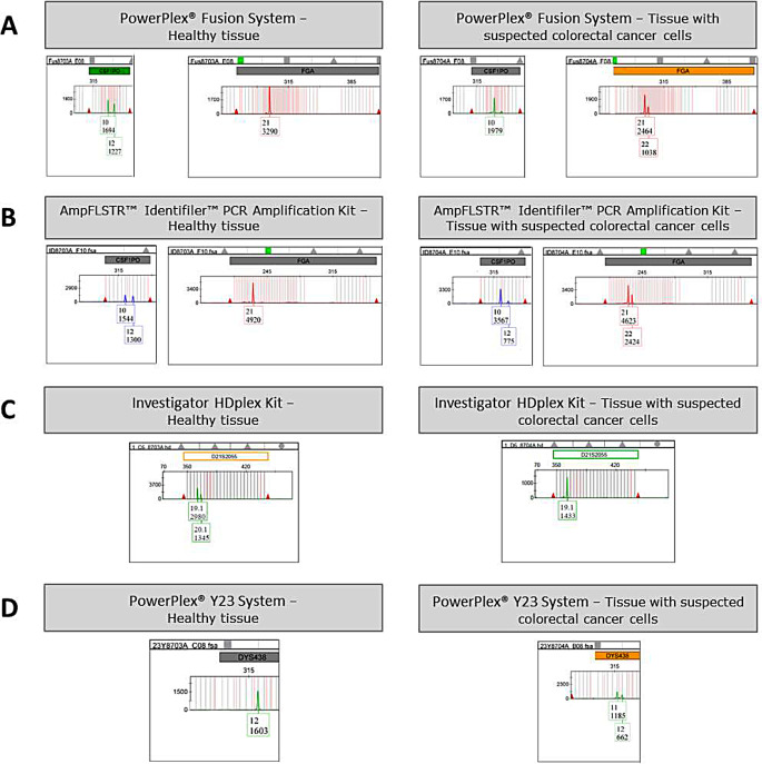 Unveiling STRs instability in a colorectal cancer FFPE sample: a case report.