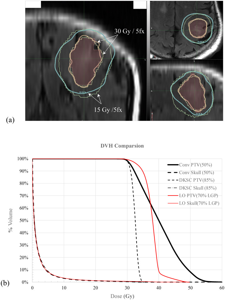 Spot-Scanning Confocal Photon Beams for Hypofractionated Brain Radiosurgery.
