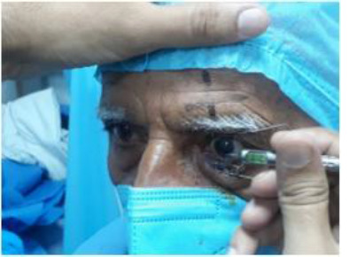 A prospective study to compare the safety and efficacy of toric intra-ocular lens vs. opposite clear corneal incision in patients undergoing phacoemulsification for age-related cataract with pre-existing corneal astigmatism.