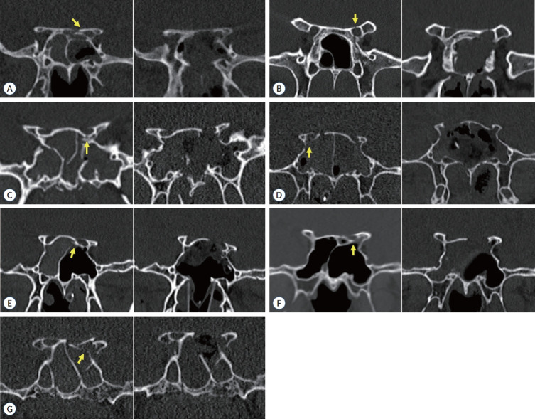 Importance of Preoperative Pupillary Reflex in Traumatic Optic Neuropathy.