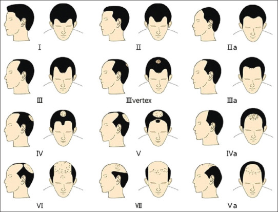 Efficiency of 5% Minoxidil and Platelet-rich Plasma Therapy in Androgenetic Alopecia - A Retrospective Study.