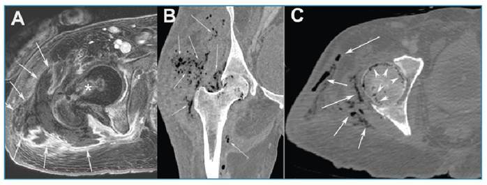 Emphysematous osteomyelitis.