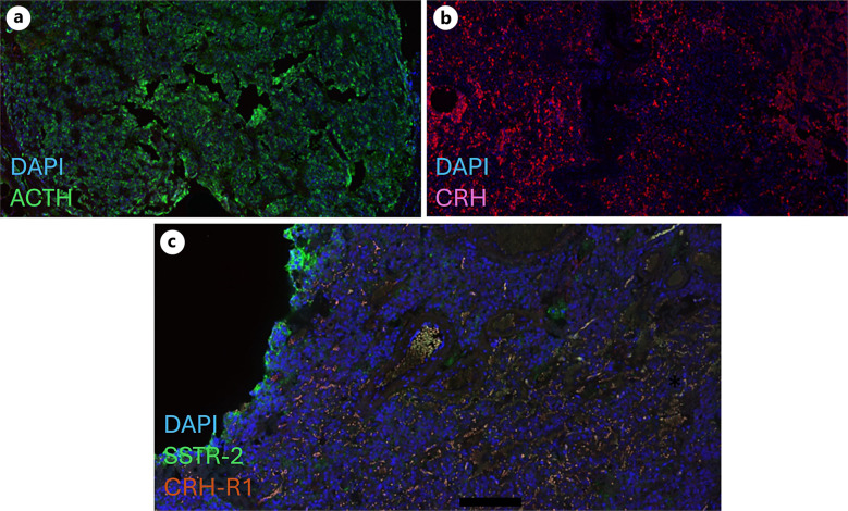 Ectopic Corticotropin-Releasing Hormone/Adrenocorticotropic Hormone-Co-Secreting Neuroendocrine Tumors Leading to Cushing's Disease: A Case Presentation and Literature Review.