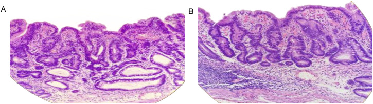 Clinical Characteristics and Pathological Features of "Crawling-type" Early Gastric Carcinoma: A Retrospective Series of Eight Cases.