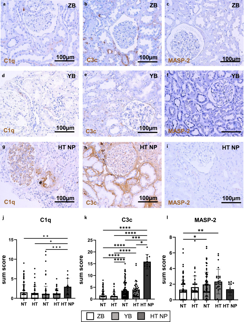 Hypertension in Living Kidney Donors Has No Effect on Complement Activation and Fibrosis.