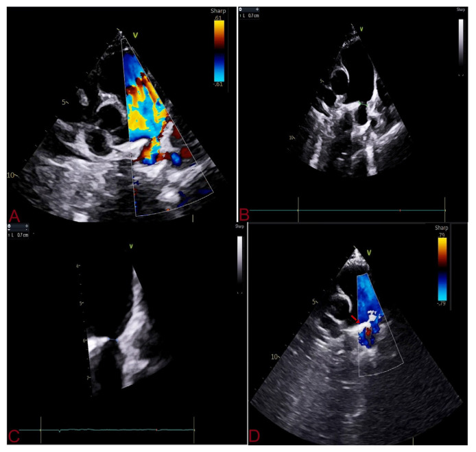 How to Avoid Arterial Access During Transcatheter Closure of Patent Ductus Arteriosus Using Anatomo-haemodynamic Landmark.