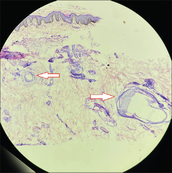 Atrichia Congenita with Papular Lesions: A Report of Rare Case Showing "Cluster of Stars' Appearance on Dermoscopy".
