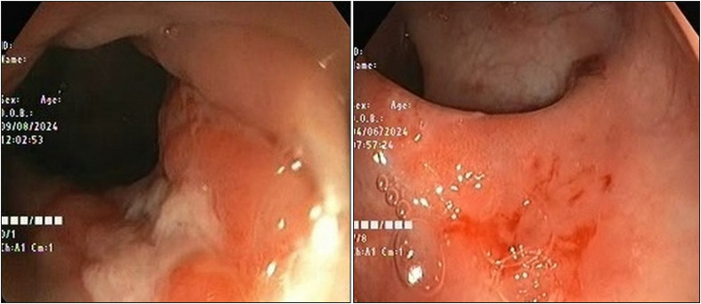 Solitary Rectal Ulcer Syndrome - A Rare Entity in the Pediatric Population.