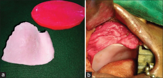 Three Fixation Techniques of Immediate Surgical Obturators Following Maxillectomy - A Comparative Study.