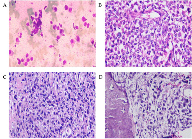 A Case of Amelanotic Plasmacytoid Melanoma with Strong CD138 Expression, Mimicking Multiple Myeloma - A Case Report.