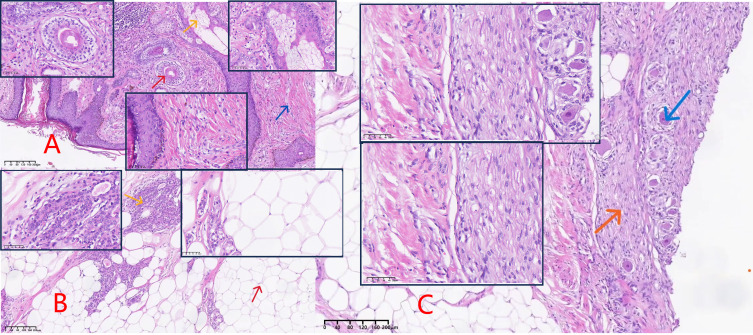 Mature Teratoma Combined with Bladder Stones: A Case Report and Literature Review.