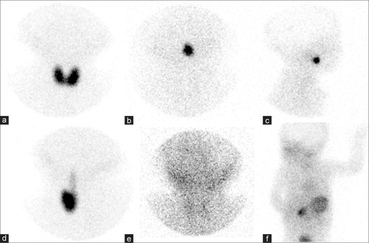 Predictive value of technetium-99m sodium pertechnetate thyroid scintigraphy in determining the permanence of congenital hypothyroidism.